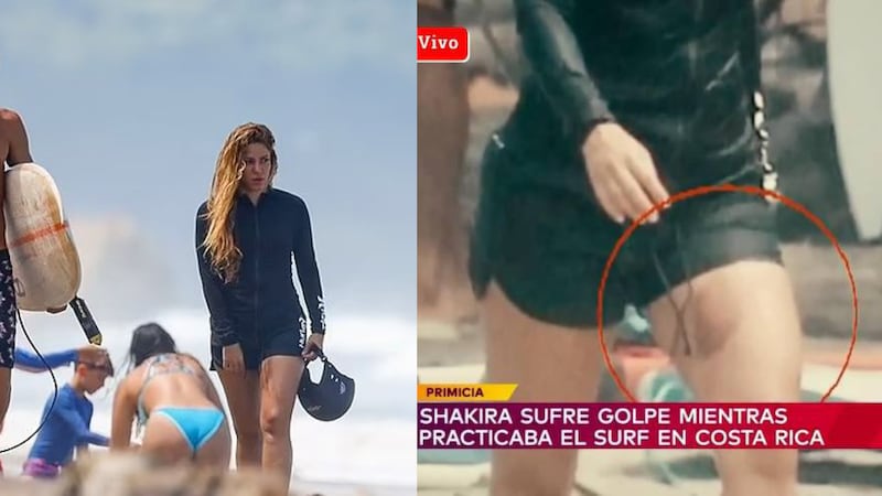 Shakira tuvo un accidente mientras surfeaba en Costa Rica: Se filtraron las fotos de los golpes