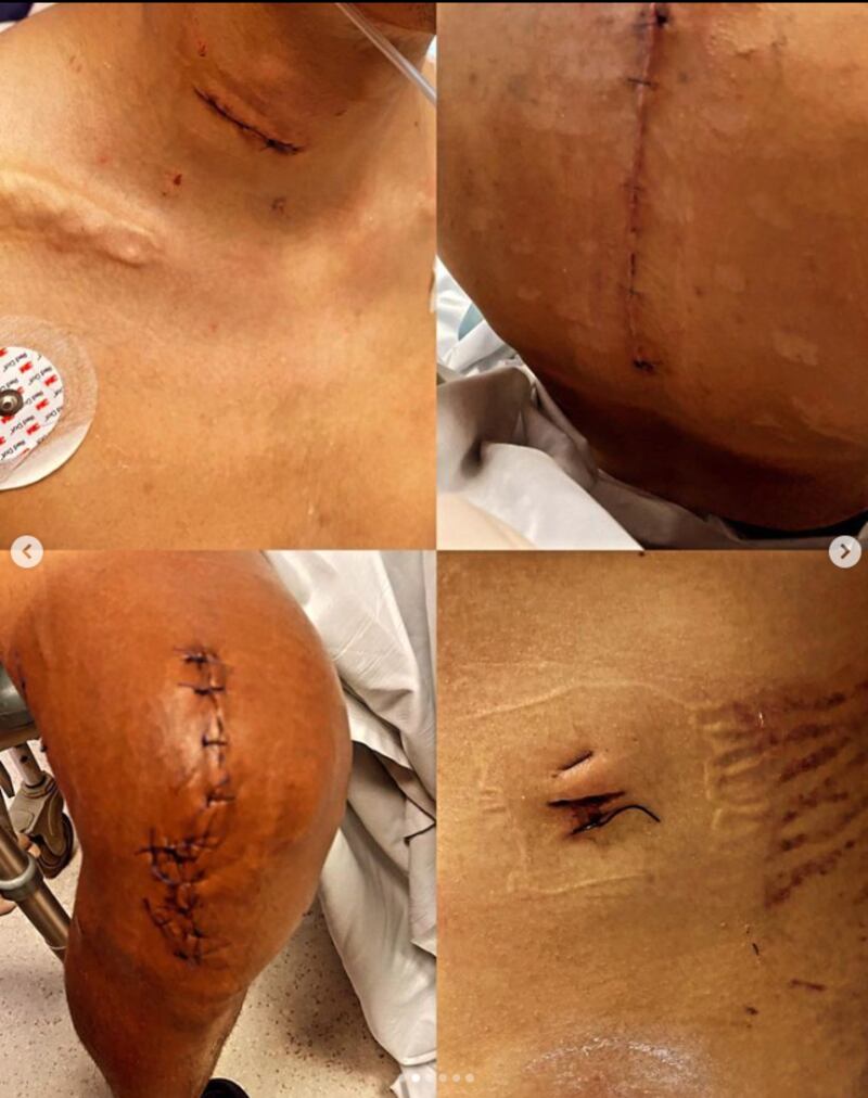 Heridas de Egan Bernal