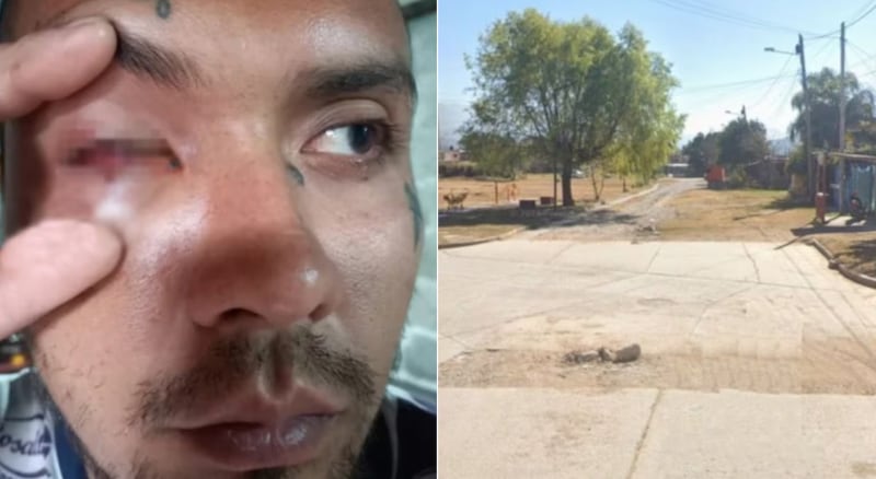 Joven perdió el ojo por un disparo policial: lo confundieron con un delincuente